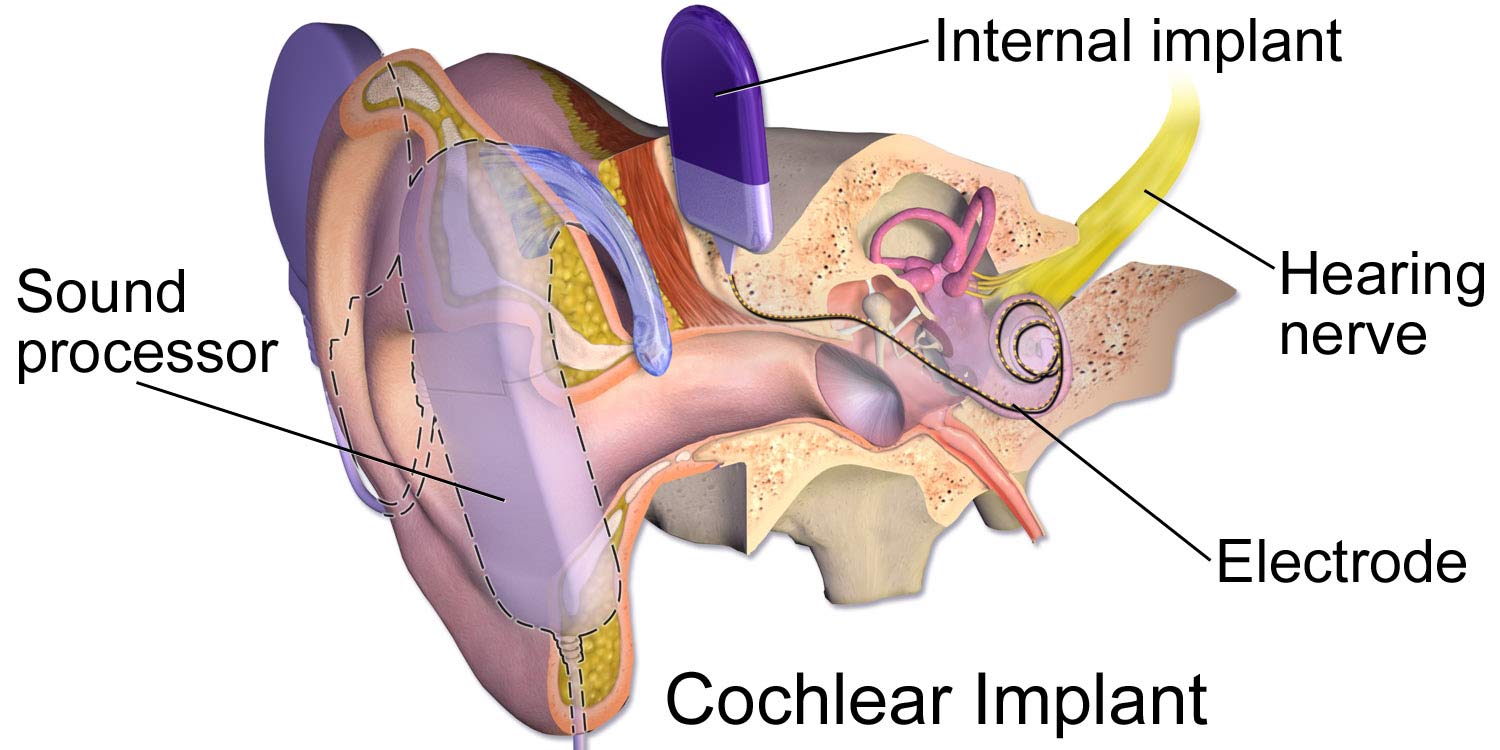An image of an ear showing a cochlear implant